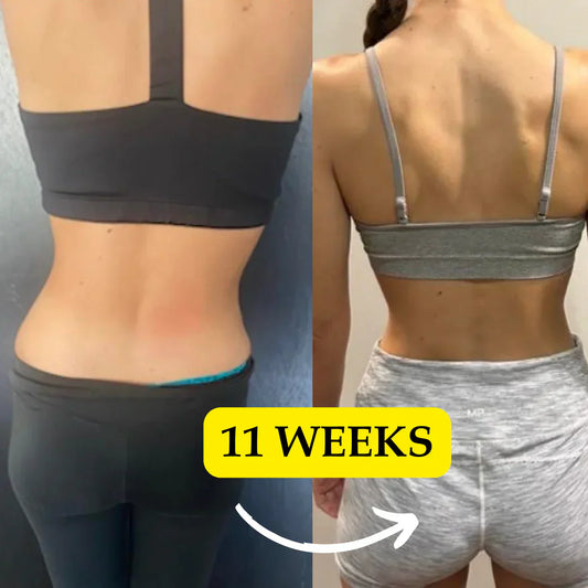 L4L5 Disc Herniation & Sciatica FULL Recovery - ONLY 11 WEEKS, 30 Min/Day with Limitless!