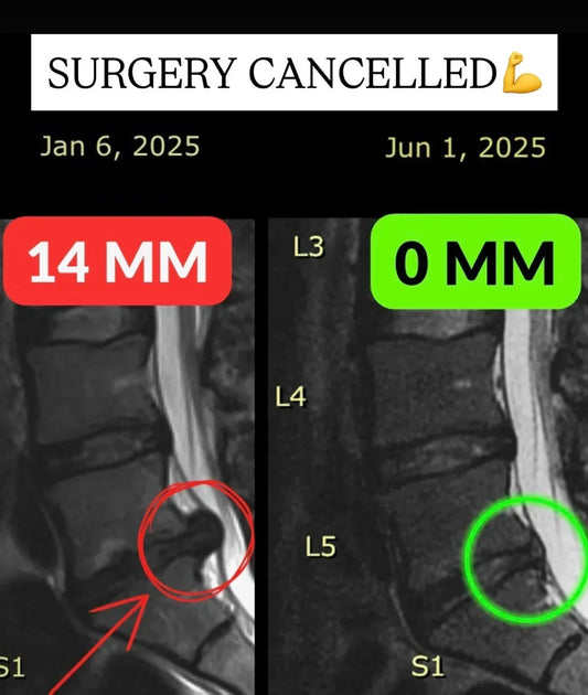 14 mm L5-S1 Disc Herniation Reduced to 0 mm in 21 Weeks (Sciatica GONE)