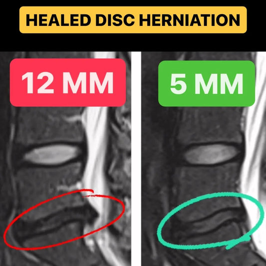 12 mm L5-S1 Disc Herniation Reduced to 5mm in 12 Weeks of Limitless (Eliminated Sciatica Too!)