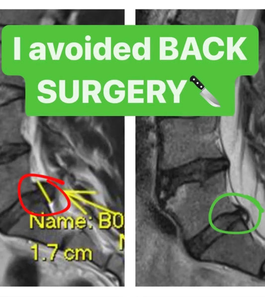 Bryan Avoids Back Surgery & Overcomes a 4CM Disc Herniation, Sciatica, Spondylolisthesis and becomes 100% PAIN FREE