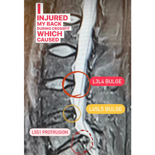 Crossfit Athlete Overcomes Pain from L3L4, L4L5 Disc Bulge, L5S1 Disc Protrusion, and Sciatica