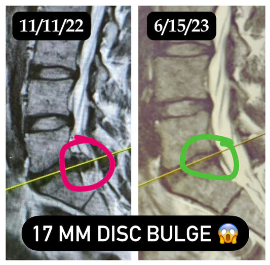 Oliver Reverses a 17 mm Disc Bulge, Eliminates Sciatica and Pain, Gets Back to Lifting