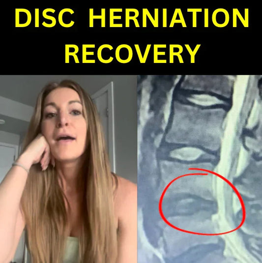Alessia Successfully Avoided Back Surgery from a SEVERE L5-S1 Disc Herniation: Healed in 3 Months of the Limitless Program