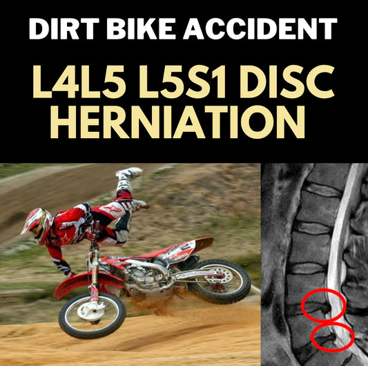 Nasty Dirt Bike Crash Led to L4L5 L5S1 Disc Herniations, Sciatica, and Severe Foot Drop: Limitless Transformation