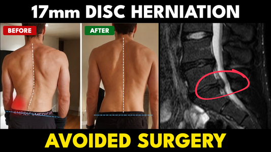 17 mm L4-L5 Disc Herniation, Sciatica and FOOT DROP: How Limitless Member Avoided Surgery